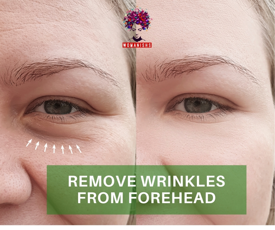 remove wrinkles from forehead